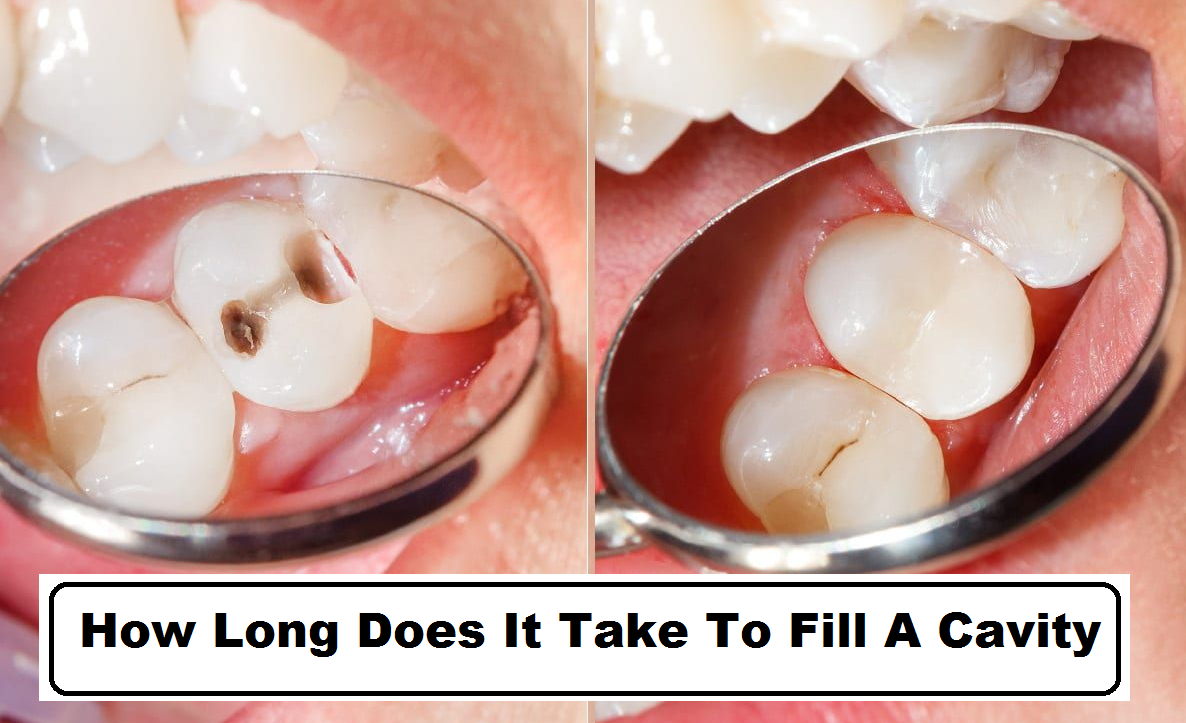 how long does it take to fill a cavity