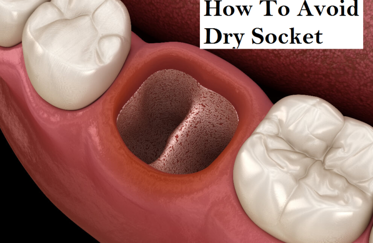 How To Avoid Dry Socket