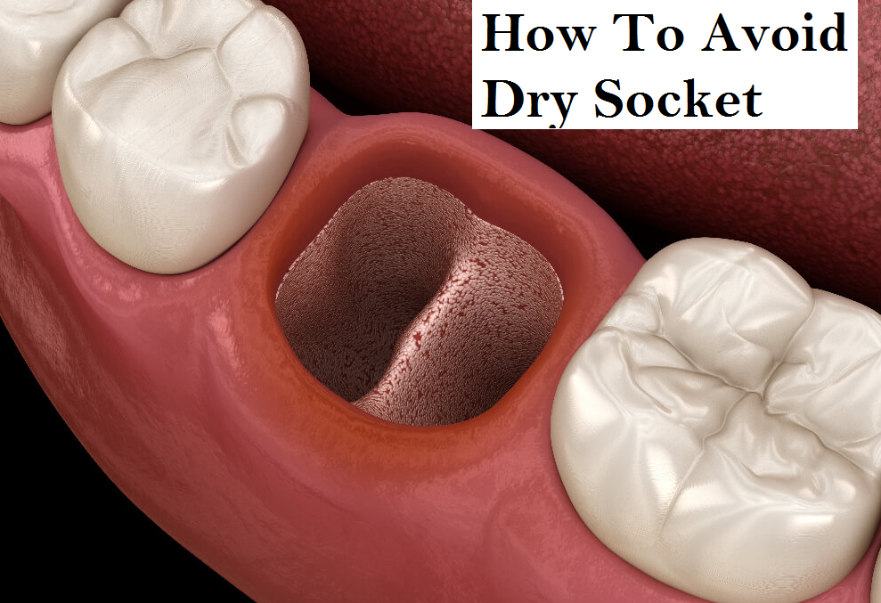 how to avoid dry socket