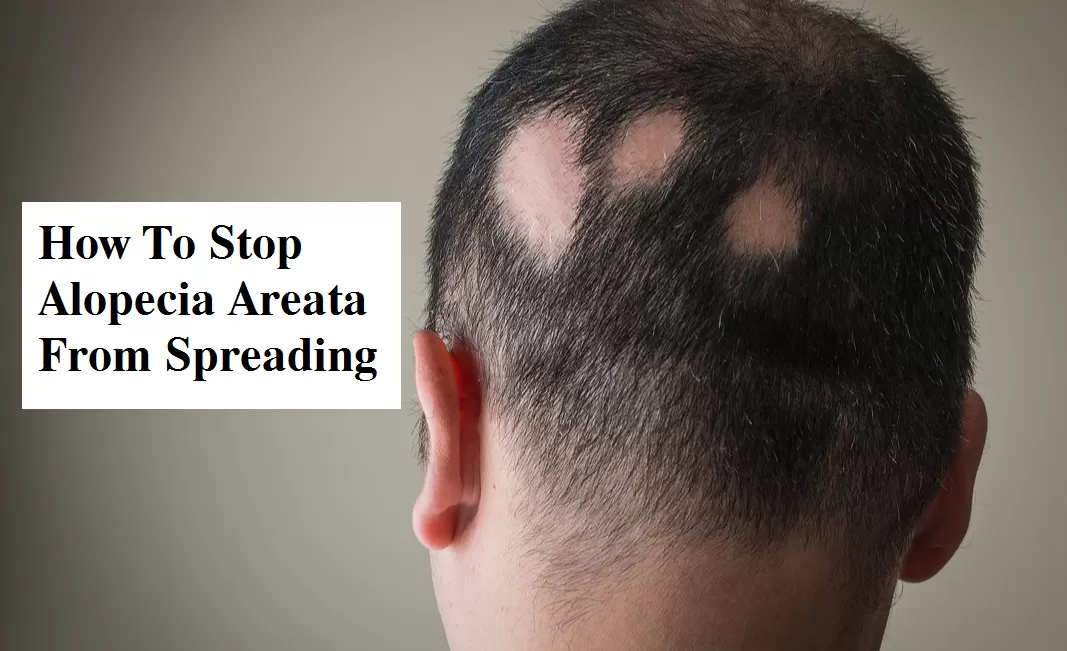 how to stop alopecia areata from spreading